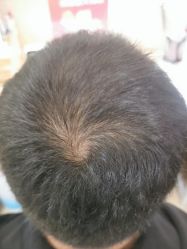 -碧莲盛·不剃发植发