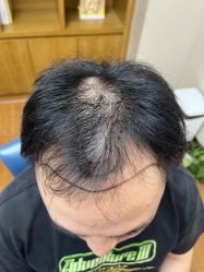 -大麦微针植发全国连锁