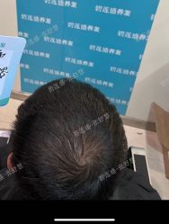 -碧莲盛·不剃发植发