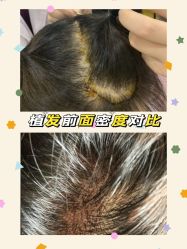 -雍禾植发