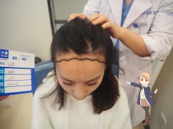 -大麦微针植发丨全国连锁