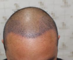 -大麦微针植发全国连锁