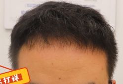 -大麦微针植发全国连锁