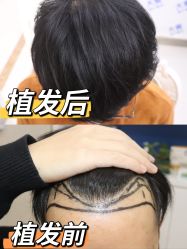 点击看大图 -大麦微针植发丨全国连锁