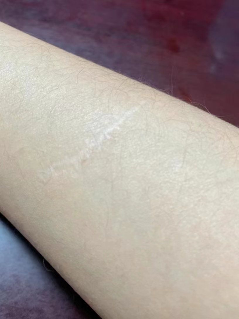 疤痕的治疗秘诀