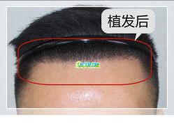 -大麦微针植发全国连锁