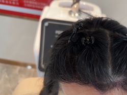 -碧莲盛·不剃发植发