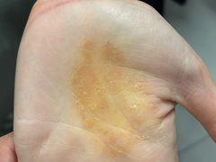 -祖传修脚甲沟炎灰指甲鸡眼