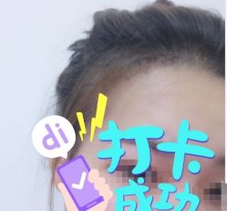 -大麦微针植发全国连锁
