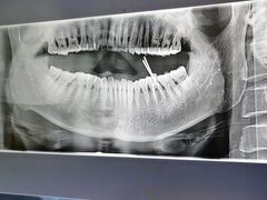 -上海仁爱医院口腔科 · 种植