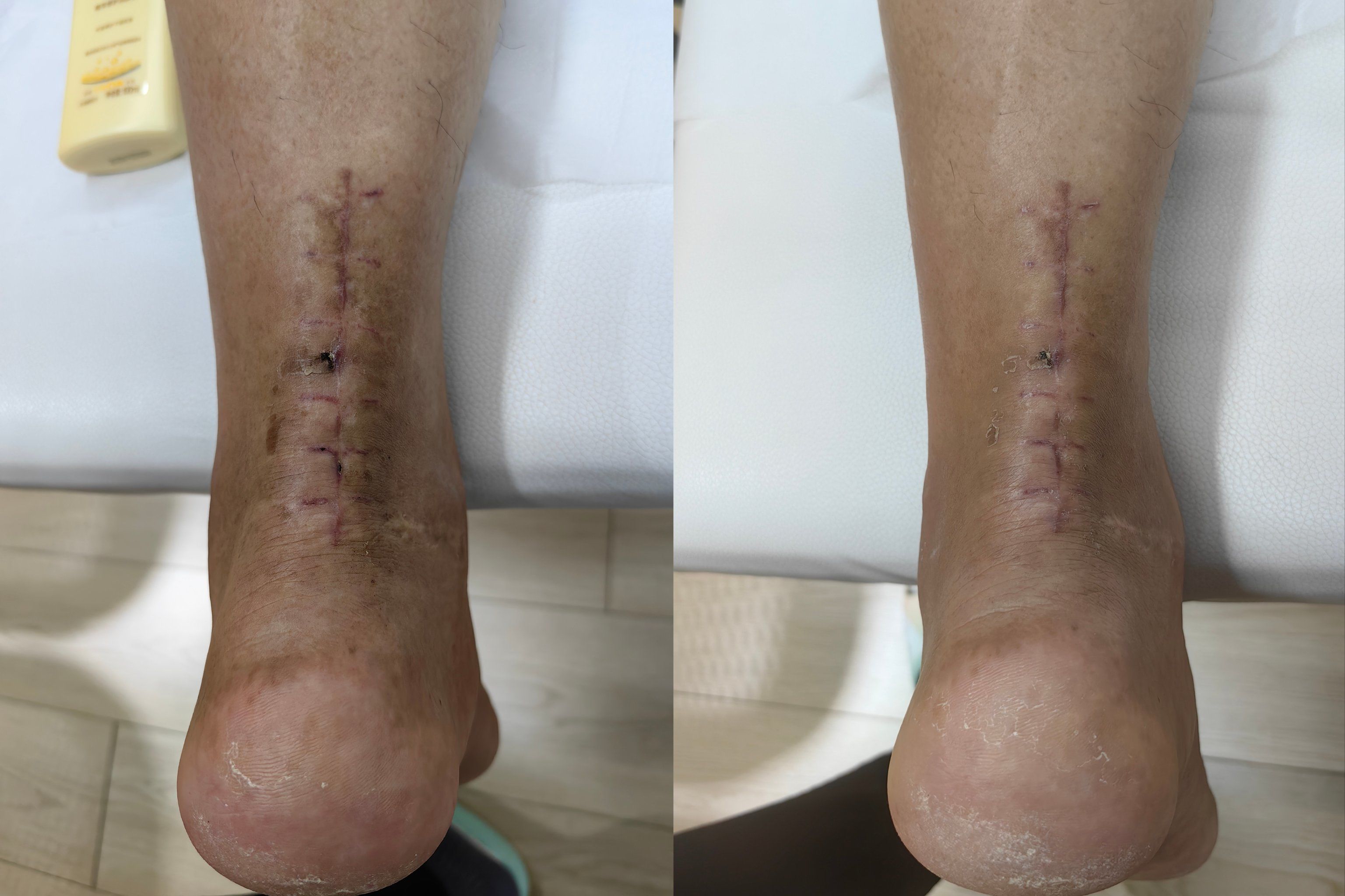 跟腱术后6到7周,要干啥