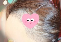 -大麦微针植发全国连锁