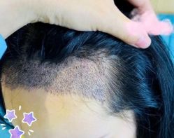 -大麦微针植发丨全国连锁