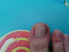 -世龙世家灰指甲鸡眼脚气甲沟炎跖疣护理(通州店)