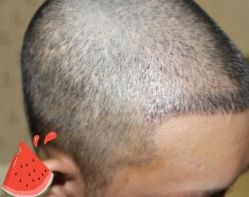 -大麦微针植发丨全国连锁