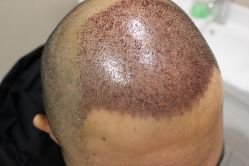 点击看大图 -大麦微针植发丨全国连锁