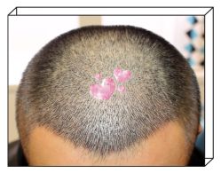 -大麦微针植发全国连锁