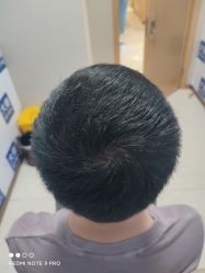 体验后-大麦微针植发丨全国连锁