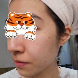 体验前-郑荃丽格医疗美容