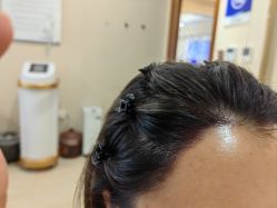 -碧莲盛·不剃发植发