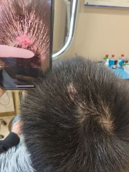 -碧莲盛·不剃发植发