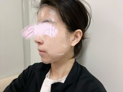 体验后-叶美人医疗美容