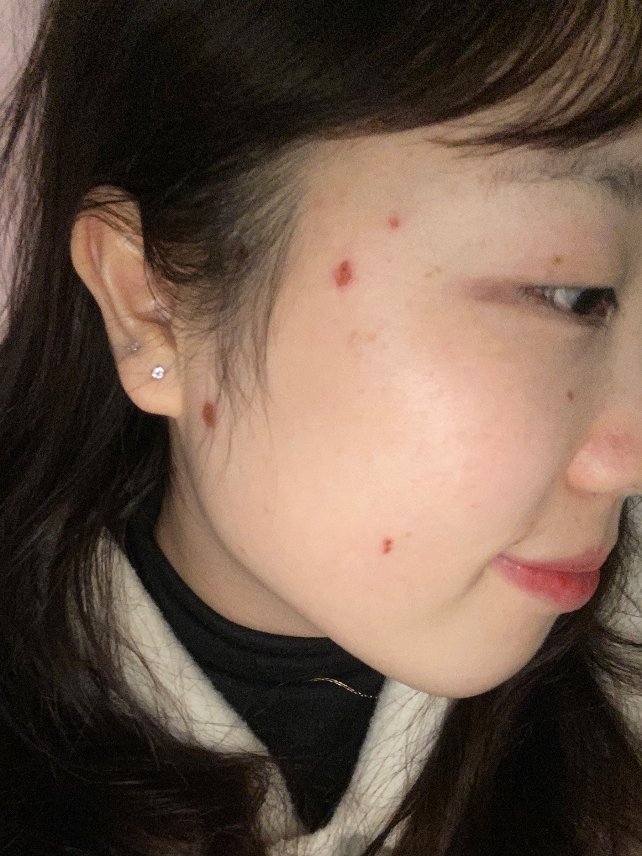 激光祛痣超满意