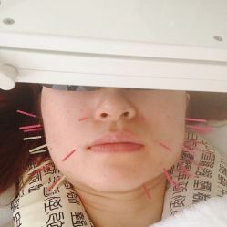 -肥三针腧穴瘦身馆