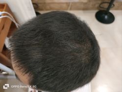 -碧莲盛·不剃发植发