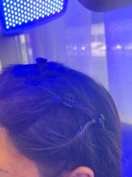 -碧莲盛·不剃发植发