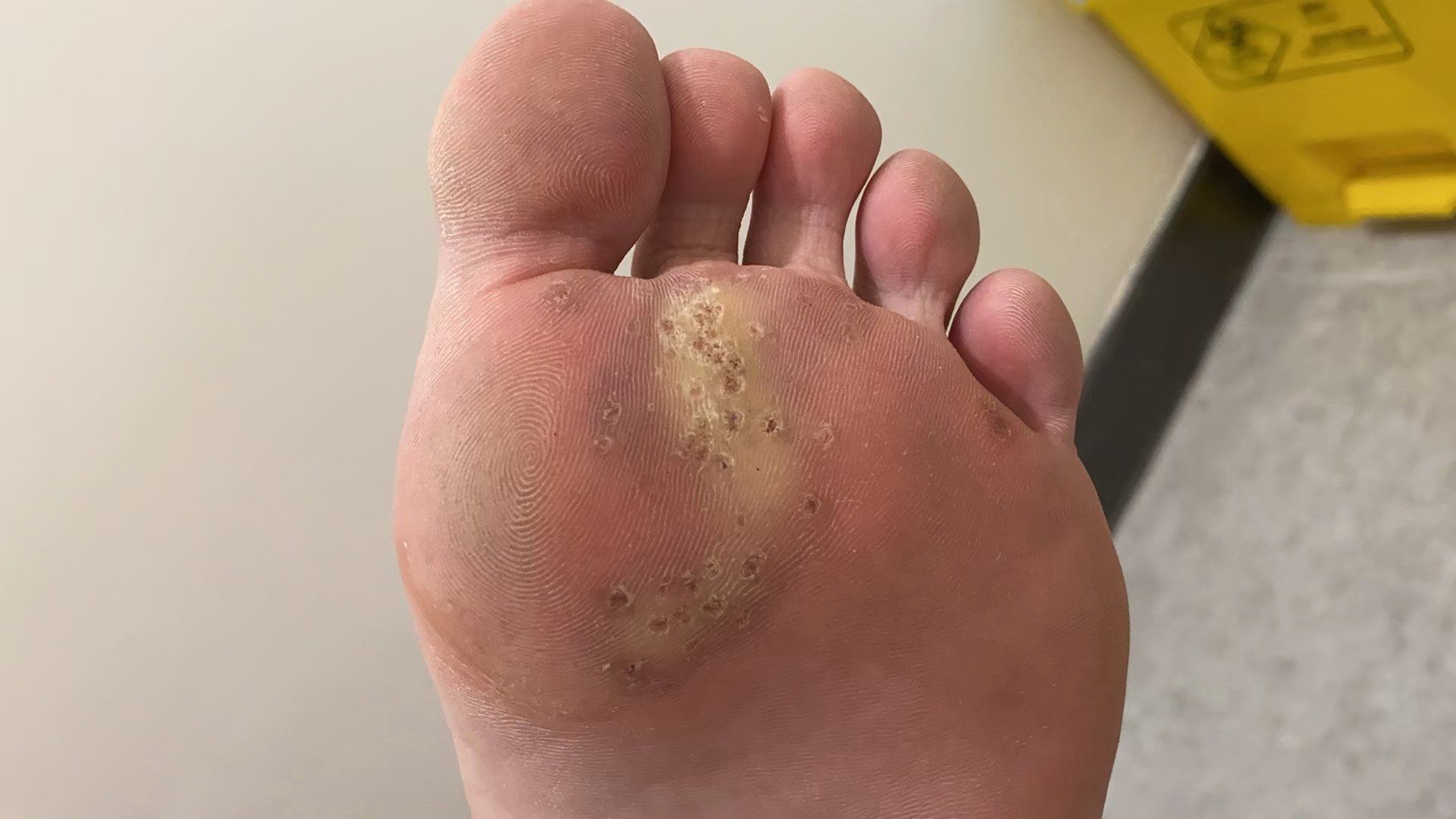 成功案例分享:跖疣客户,发现跖疣的时候用