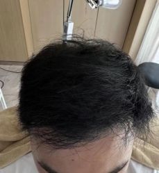 -大麦微针植发丨全国连锁