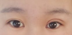 体验后-丰联丽格医疗美容·联合丽格眼整形中心
