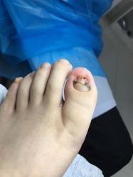 -派恩宜灰指甲鸡眼嵌甲手足癣