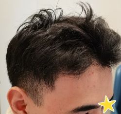 -大麦微针植发丨全国连锁