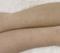 -薇兰专业脱毛连锁机构