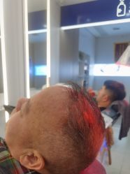 体验后-大麦微针植发全国连锁