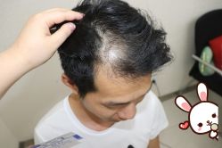 -大麦微针植发丨全国连锁