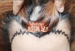 -大麦微针植发全国连锁