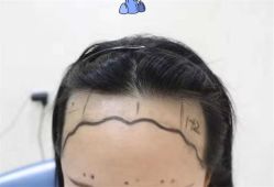 点击看大图 -大麦微针植发全国连锁