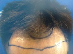 -雍禾植发全国连锁