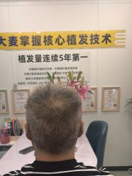 -大麦微针植发全国连锁