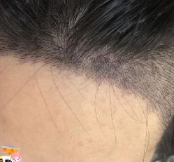 -大麦微针植发丨全国连锁