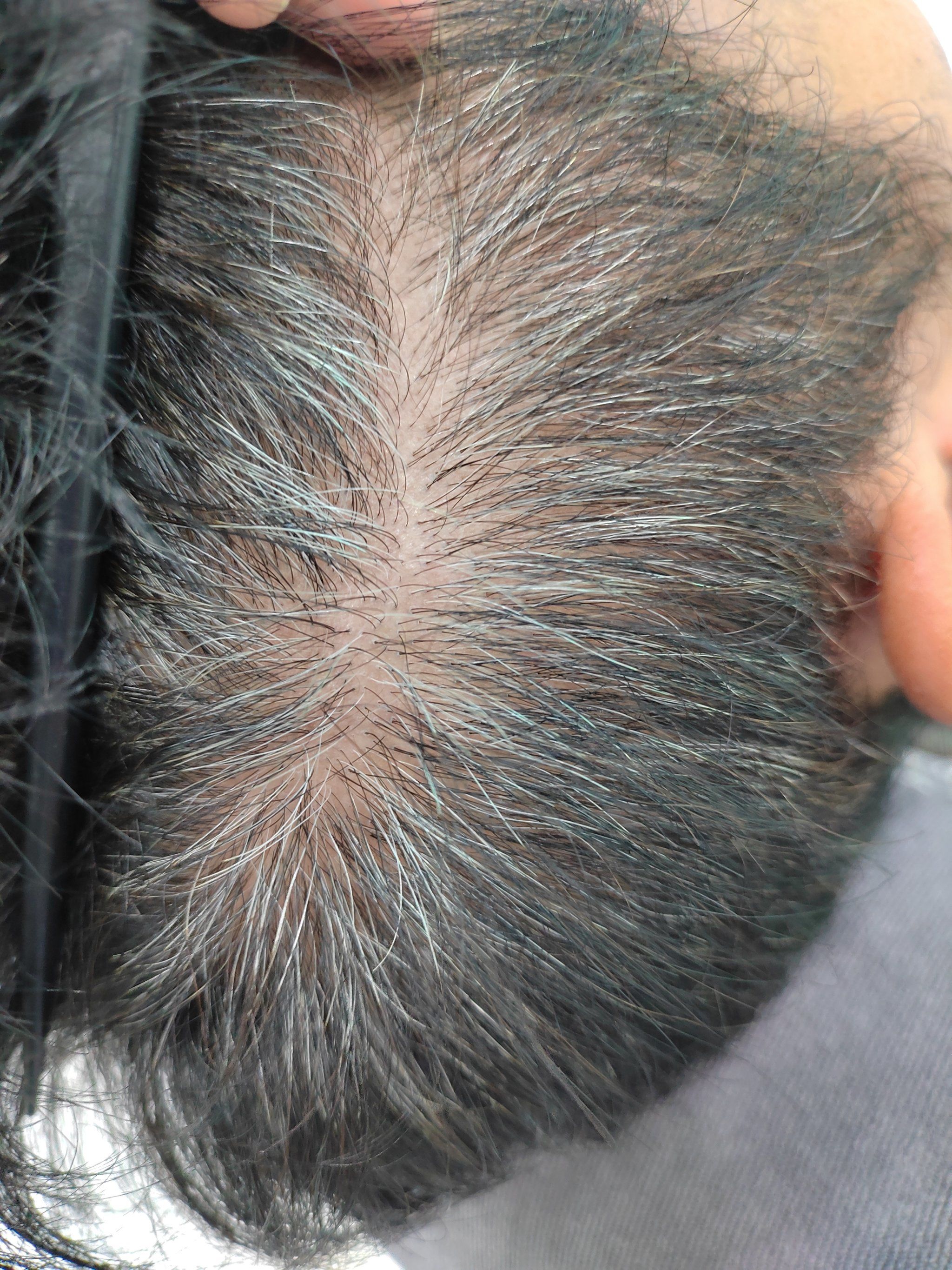 一个92年男生白发的自述