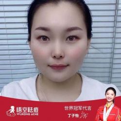 -悟空祛痘·诺奖技术专业店