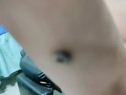 -百年美肤堂祛痦痣祛斑祛疣