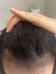 -大麦微针植发丨全国连锁