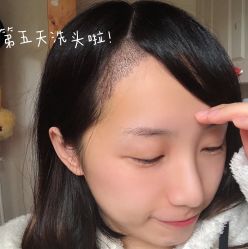 -碧莲盛不剃发植发