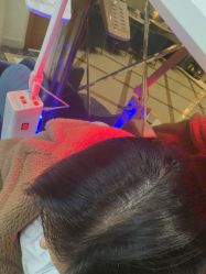 -碧莲盛·不剃发植发