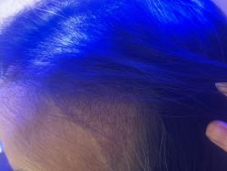 -碧莲盛·不剃发植发